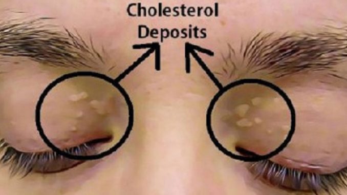 How to Remove the Cholesterol Deposits Around Your Eyes
