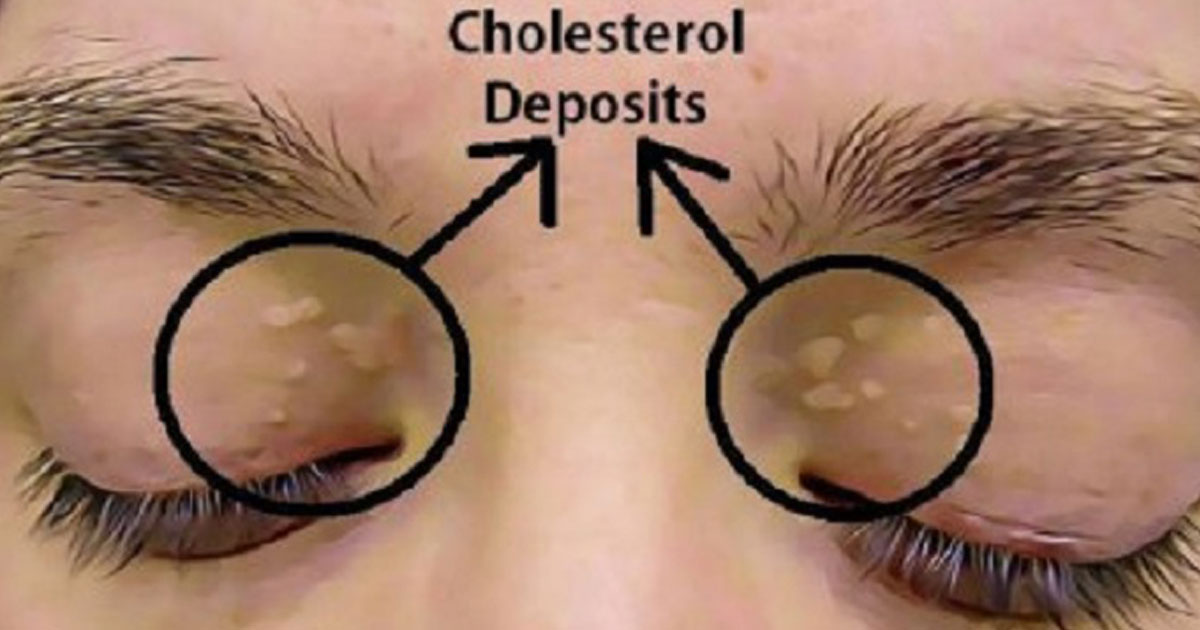 How to Remove the Cholesterol Deposits Around Your Eyes