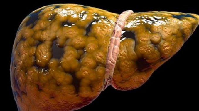 FATTY LIVER DOESN’T SHOW UP IN SCANS UNTIL IT’S TOO LATE. HERE ARE 7 EARLY WARNING SIGNS TO LOOK OUT FOR FATTY LIVER DOESN’T SHOW UP IN SCANS UNTIL IT’S TOO LATE. HERE ARE 7 EARLY WARNING SIGNS TO LOOK OUT FOR
