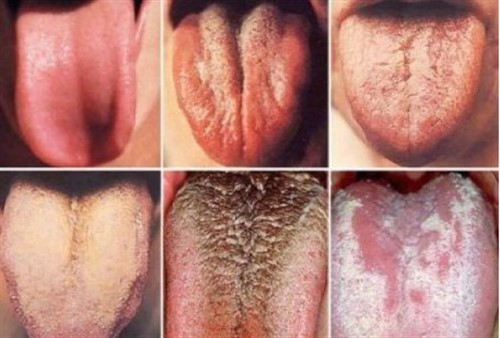 PAY CLOSE ATTENTION TO YOUR TONGUE, IT MIGHT BE SHOWING YOU SIGNS OF CERTAIN HEALTH PROBLEMS.