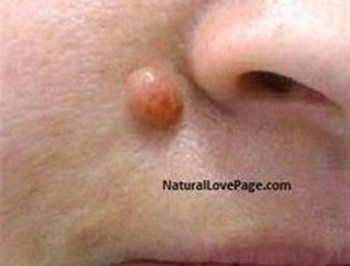 Destroy Your Moles, Warts, Blackheads, Skin Tags And Age Spots Completely Naturally