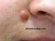 Destroy Your Moles, Warts, Blackheads, Skin Tags And Age Spots Completely Naturally