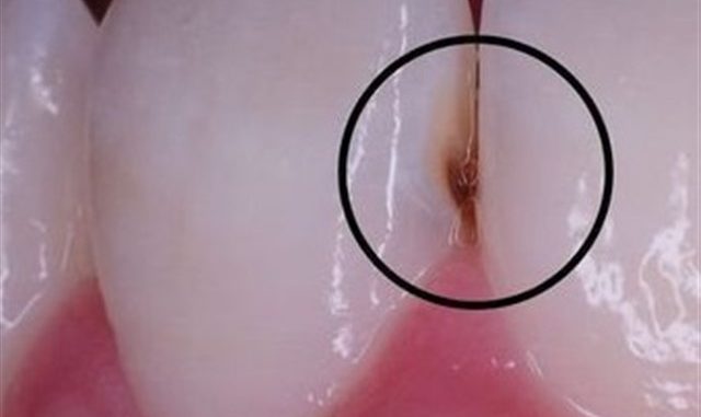 GET RID OF TOOTH DECAY AND CAVITIES NATURALLY WITH THESE AMAZING HOMEMADE TOOTH MASKS! GET RID OF TOOTH DECAY AND CAVITIES NATURALLY WITH THESE AMAZING HOMEMADE TOOTH MASKS!
