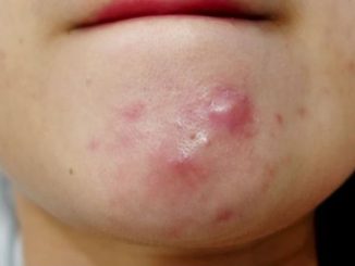 What type of pimples you have and how to get rid of them