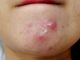 What type of pimples you have and how to get rid of them