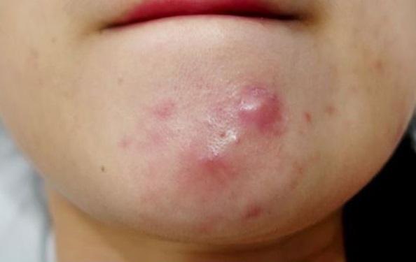 What type of pimples you have and how to get rid of them