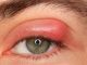 HOW TO CURE AN EYE INFECTION IN JUST 24 HOURS WITH THIS HOME REMEDY?