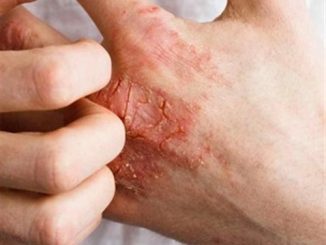 Apple cider vinegar for eczema: How it works and uses