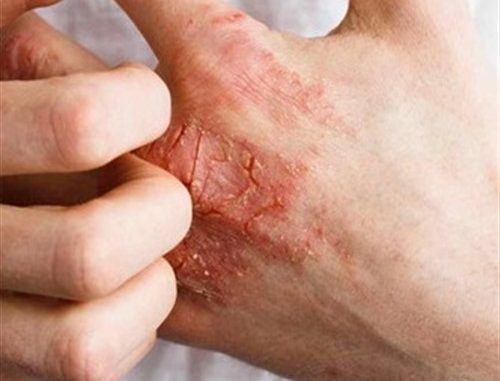 Apple cider vinegar for eczema: How it works and uses