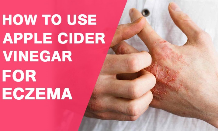 Apple cider vinegar for eczema: How it works and uses?