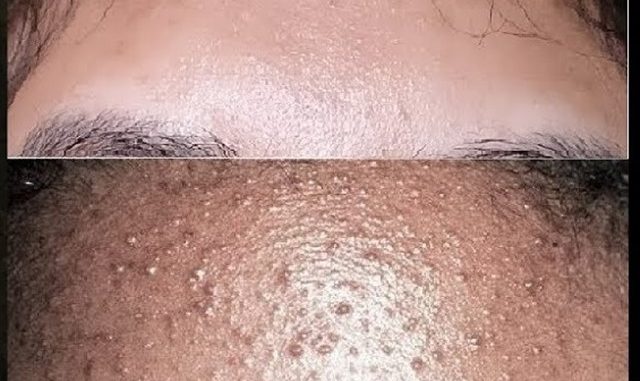 5 Best Ways to Clear Up Forehead Acne 5 Best Ways to Clear Up Forehead Acne