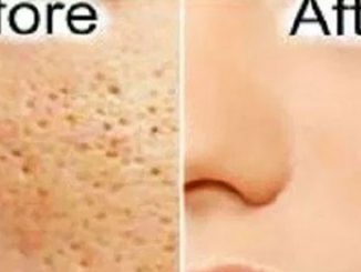 All Open Pores Will Disappear from Your Skin Forever – Just In 3 Days