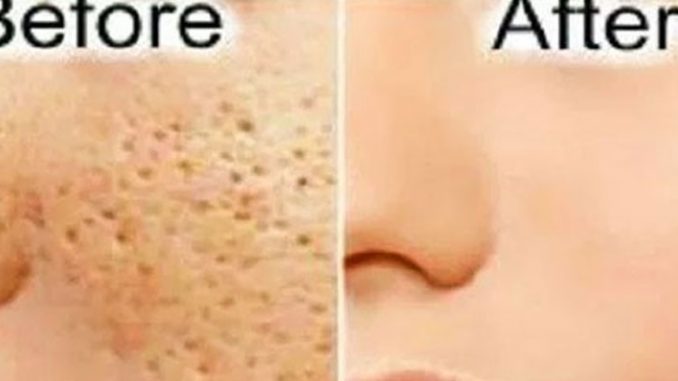 All Open Pores Will Disappear from Your Skin Forever – Just In 3 Days