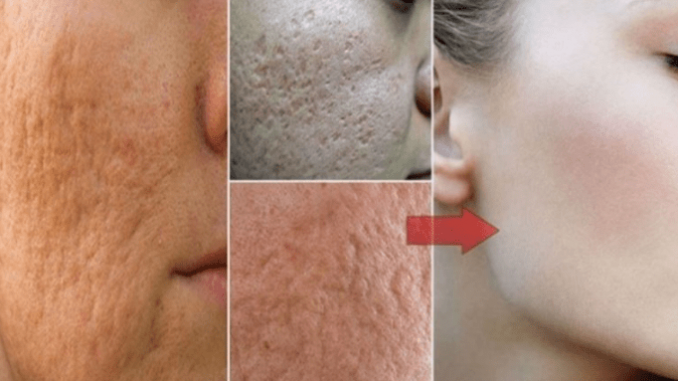How To Make Pores Disappear With Only 1 Ingredient Naturally How To Make Pores Disappear With Only 1 Ingredient Naturally