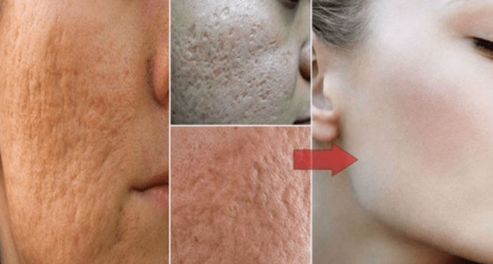How To Make Pores Disappear With Only 1 Ingredient Naturally