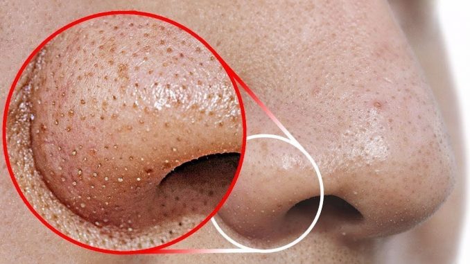 Remove BLACKHEADS / WHITEHEADS At Home In Just 2 Minutes (Best And Easy Way)