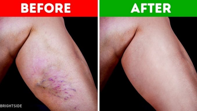 How To Get Rid of Varicose Veins Naturally at Home