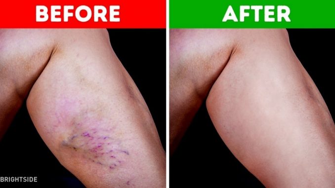 How To Get Rid of Varicose Veins Naturally at Home How To Get Rid of Varicose Veins Naturally at Home