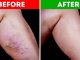 How To Get Rid of Varicose Veins Naturally at Home