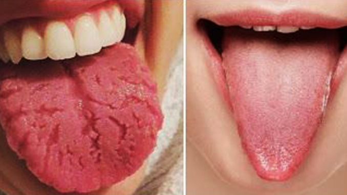 Find Out What Your Tongue Is Trying To Tell You
