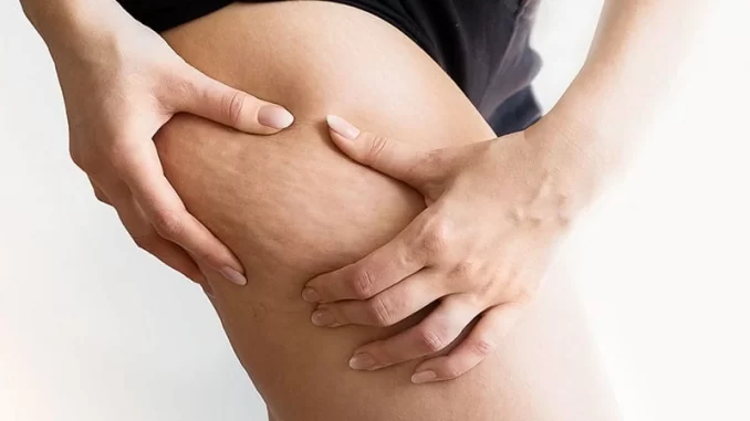 7 Exercises To Get Rid Of Cellulite On Thighs And Butt