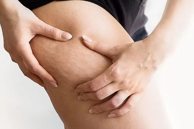 7 Exercises To Get Rid Of Cellulite On Thighs And Butt